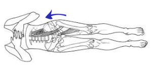 عکس کوتاهی پا عملکردی به دلیل ضعف عضلات و چرخش لگن یکی از پا کوتاه تر شده است