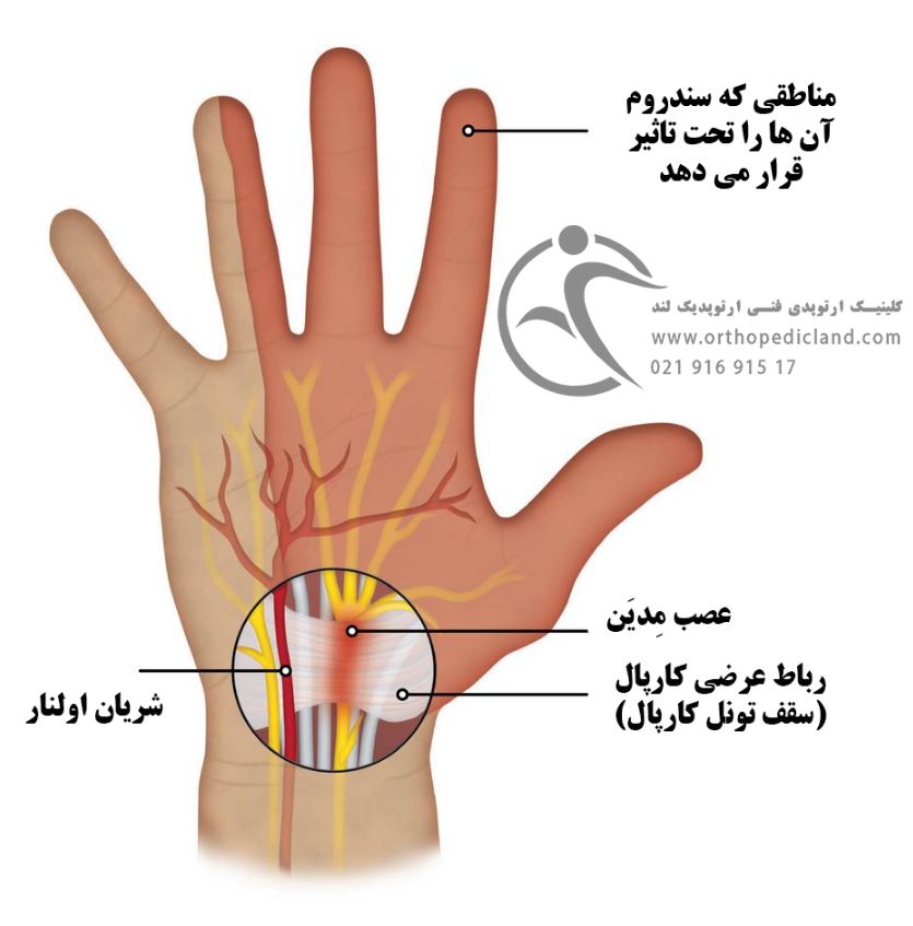 علت درد مچ دست در اثر سندروم تونل کارپال چیست؟